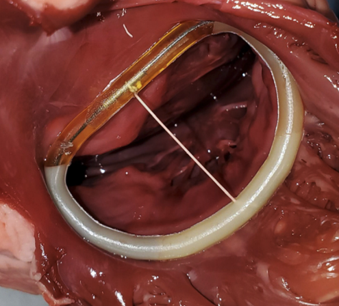 DynaRing Mitral Annuloplasty Ring